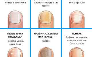 Как выглядит грибок ногтей, фото