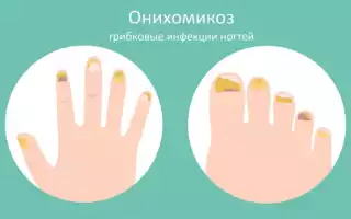 Лечение грибка ногтей в домашних условиях — самый быстрый способ