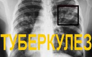 Причины, первые симптомы и народное лечение туберкулеза