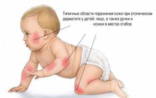 Атопический дерматит у детей: лечение и фото