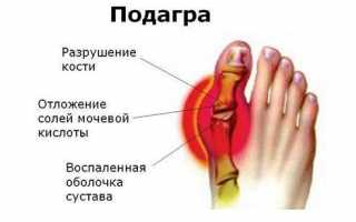 Избавляемся от подагры на ногах, лечение болезни