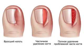 Удаление вросшего ногтя на ноге