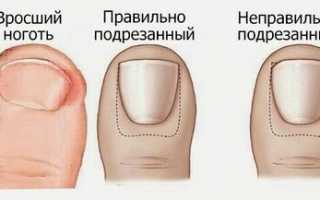 Кюретка для педикюра для вросшего ногтя