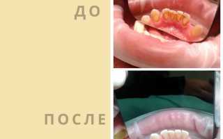 Какие последствия частого чистения зубов один раз в день: объяснение ортодонта