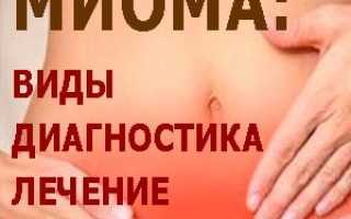 Миома матки — виды, диагностика, лечение и профилактика