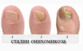 Демиктен лак от грибка ногтей: отзывы, цена и описание препарата