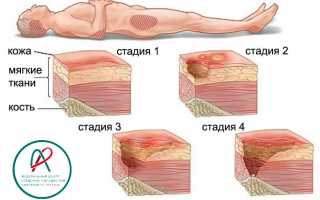 Что такое пролежни: причины, стадии, признаки