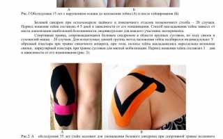 Кинезиотейпирование: процедура, показания и эффект