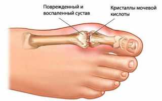 Диета при подагре. Таблица продуктов: что нельзя есть (меню). Подробное описание