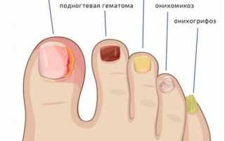 Что такое грибок ногтей и как определить что это он?