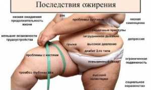 Ожирение: как определить, причины и последствия для здоровья