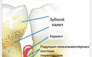 Пародонтоз: лечение народными средствами — самое эффективное