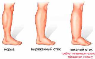 Отечность в щиколотках – серьезная ли проблема?
