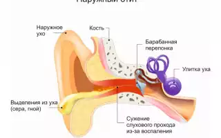 Как лечить пролежни в ухе – особенности, приемы и медикаменты