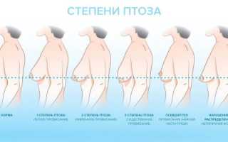 Увеличение груди: от чего зависит стоимость маммопластики