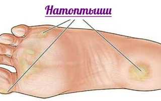Натоптыши на подошве со стержнем: лечение, фото ступней