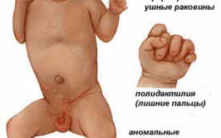 Синдром Патау: фото, описание основных признаков и симптомов