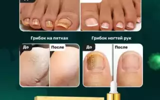 Отзывы: Лечение грибка ногтей на ногах — препараты