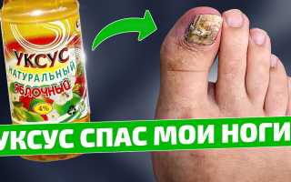 Яблочный уксус против грибка ногтей на ногах. Можно ли вылечить запущенную форму?