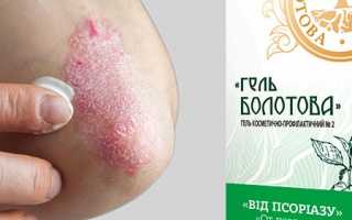 Псориаз: лечение в домашних условиях и методы лечения