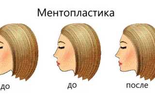 Ментопластика: корректировка формы подбородка