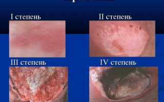 Пролежни на спине – особенности и лечение