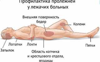 Пролежень под гипсом: причины, лечение и профилактика