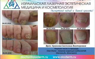 Грибок кандида на ногах, лечение и отзывы