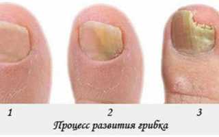 Как и чем вылечить грибок ногтей на ногах быстро?