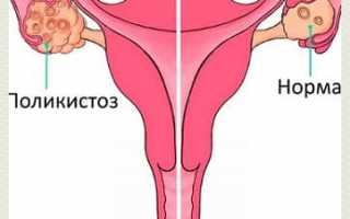 Лечение и питание при поликистозе яичников