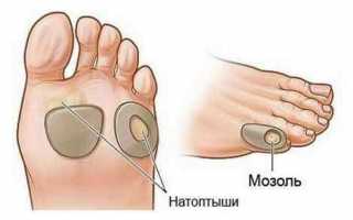 Как избавиться от мозолей на пальцах ног
