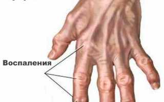 Ревматоидный артрит. Основные симптомы и лечение данного заболевания