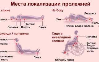 Температура при пролежнях у лежачих больных