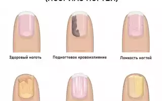 Псориаз ногтей, причины возникновения и лечение болезни