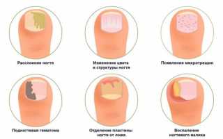 Как размягчить ногти на ногах при грибке? Как правильно распарить?