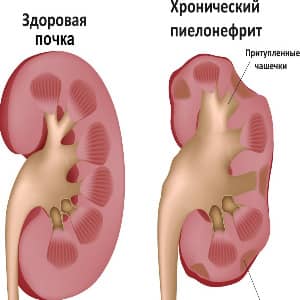 Пиелонефрит причины заболевания