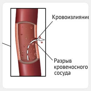 Инсульт какие признаки бывают