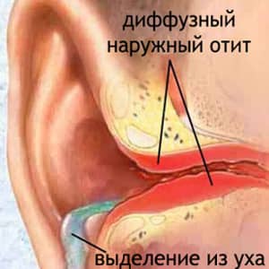 Виды отита