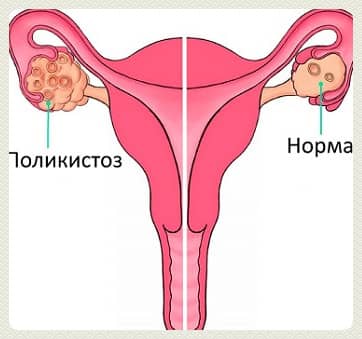 Поликистоз яичников