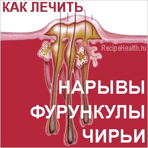 Как лечить нарывы и чирьи