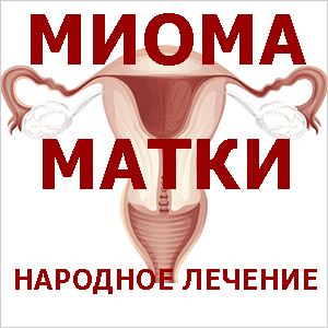 миома матки стадии