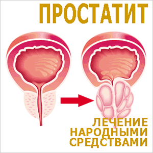 мужская болезнь простатит - лечение