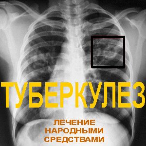Рентген - туберкулез
