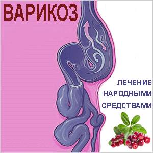 Лечение варикоза