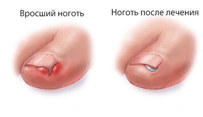 Вросший ноготь фото до и после операции