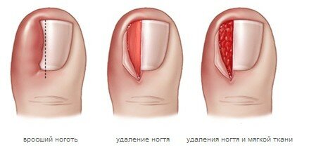 Вросший ноготь фото до и после операции
