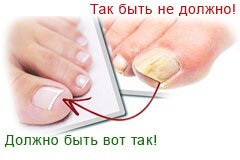 Демиктен лак от грибка ногтей: отзывы, цена и описание препарата 