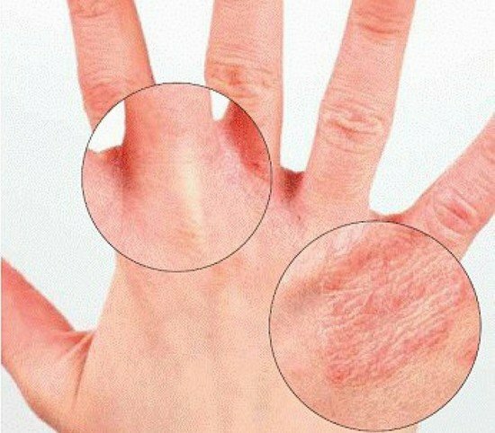 Как проявляются болезни кожи на руках?