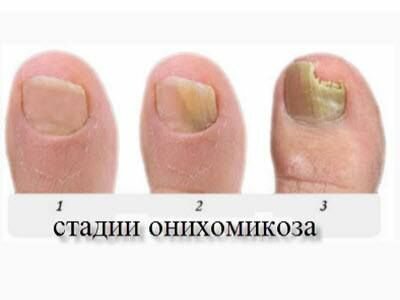 Клотримазол от грибка ногтей, цены и отзывы