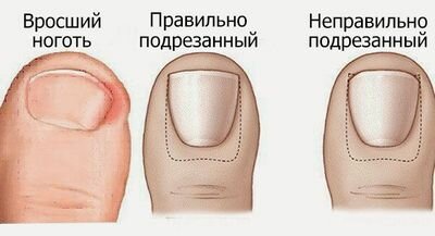 Помогите: ноготь врастает в палец